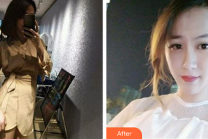 中信惠州醫(yī)院醫(yī)學(xué)整形中心吳正峯整形價(jià)格表附點(diǎn)陣激光祛妊娠紋案例展示