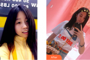 中信惠州醫(yī)院醫(yī)學(xué)整形中心王少榮整形價(jià)格表附超聲波潔牙案例展示