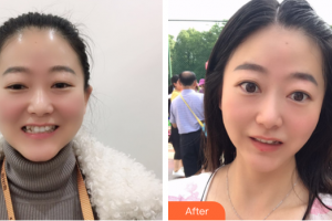 中信惠州醫(yī)院醫(yī)學(xué)整形中心單成方整形價(jià)格表附隱形牙齒案例展示