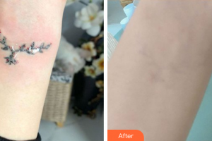 惠州伊麗莎白整形美容醫(yī)院高珊整形價(jià)格表附超激光美膚洗紋身案例展示