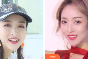 惠州鵬愛(ài)醫(yī)療美容醫(yī)院張澤火整形價(jià)格表附隱形托槽矯正案例展示