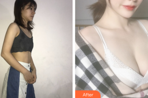 惠州元辰醫(yī)療美容門診部袁新平整形價(jià)格表附假體隆胸案例展示