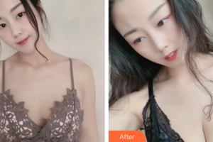 惠州微美醫(yī)療美容診所高清華整形價(jià)格表附自體脂肪隆胸案例展示