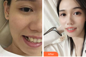 惠州白天鵝口腔醫(yī)院張梅梅整形價(jià)格表附牙齒矯正案例展示