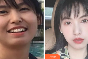 惠州白天鵝口腔醫(yī)院陳士秀整形價(jià)格表附牙齒矯正案例展示