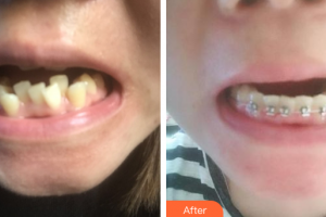 惠州白天鵝口腔醫(yī)院何常英整形價(jià)格表附金屬托槽矯正案例展示