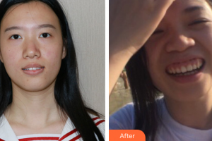 惠州白天鵝口腔醫(yī)院付美清整形價(jià)格表附隱形托槽矯正案例展示