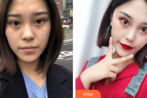 惠州伊麗莎白整形美容醫(yī)院陶溯整形價格表附超微小氣泡案例展示