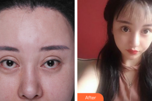惠州元辰醫(yī)療美容門診部李震整形價格表附失敗重瞼修復(fù)+上瞼下垂矯正案例展示