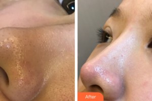 惠州元辰醫(yī)療美容門診部張琳整形價(jià)格表附清潔祛痘案例展示