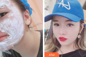 中信惠州醫(yī)院醫(yī)學(xué)整形中心余文建整形價(jià)格表附微針美膚案例展示