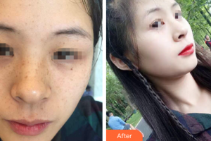 惠州劉偉勇醫(yī)療美容診所劉曉韜整形價(jià)格表附激光祛斑案例展示