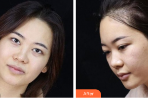 惠州市第一人民醫(yī)院眼科丁嬙整形價(jià)格表附眼部綜合案例展示