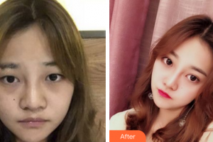 惠州市第一人民醫(yī)院眼科馮育基整形價(jià)格表附眼部手術(shù)案例展示