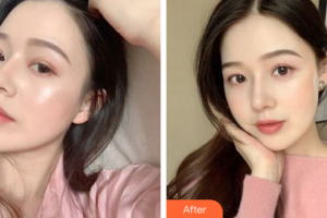 惠州市第六人民醫(yī)院眼科葉洪娜整形價格表附眼部整形案例展示