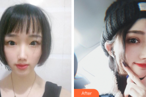 惠州市第一人民醫(yī)院眼科廖潤斌整形價格表附雙眼皮案例展示