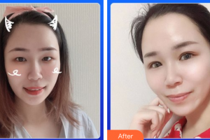 惠州市第一人民醫(yī)院眼科蔡樹泓整形價格表附眼部綜合案例展示