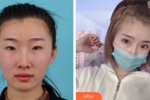 惠州市第六人民醫(yī)院眼科袁釗華整形價格表附眼部整形案例展示