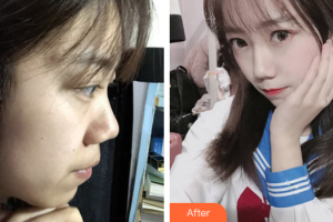 韶關(guān)市粵北人民醫(yī)院整形美容科羅冠雛整形價格表附微針美塑案例展示