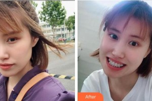 杭州品凱口腔醫(yī)院劉鋼才整形價格表附金屬托槽矯正案例展示