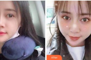 杭州品凱口腔醫(yī)院張衛(wèi)中整形價格表附自鎖托槽矯正案例展示