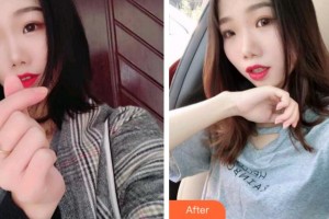 杭州品凱口腔醫(yī)院芳整形價格表附牙齒隱形矯正案例展示