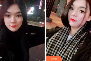 杭州品凱口腔醫(yī)院秦芳整形價格表附牙齒隱形矯正案例展示