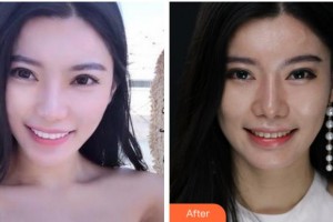 杭州品凱口腔醫(yī)院沈麗娜整形價格表附美白貼片案例展示