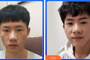 杭州市富陽區(qū)中醫(yī)院眼科張建亨整形價格表附切開雙眼皮案例展示