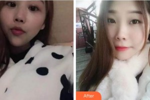 杭州富陽口腔醫(yī)院賈珂整形價格表附自鎖托槽矯正案例展示