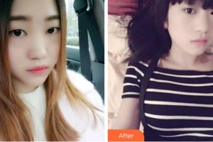 杭州亮貝美口腔醫(yī)院趙媛整形價格表附金屬托槽矯正案例展示