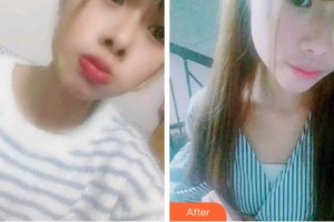 杭州亮貝美口腔醫(yī)院蔣賢軍整形價格表附根管調(diào)節(jié)案例展示