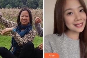 杭州維信口腔門診部古新月整形價格表附金屬托槽矯正案例展示