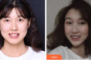 杭州博凡口腔門診部鄭春穎整形價(jià)格表附牙齒隱形矯正案例展示