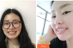 杭州西湖口腔醫(yī)院武鑫茹整形價(jià)格表附金屬托槽矯正案例展示