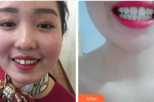 杭州國(guó)雅口腔醫(yī)院萬成鋒整形價(jià)格表附牙齒隱形矯正案例展示