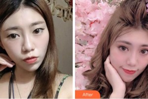 杭州太學(xué)眼科門診部董媛整形價(jià)格表附眼部綜合案例展示