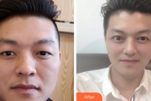 杭州太學(xué)眼科門診部周玉柱整形價(jià)格表附切開雙眼皮案例展示