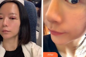 杭州太學(xué)眼科門診部林丕容整形價(jià)格表附切開雙眼皮案例展示
