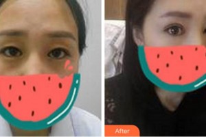杭州愛爾眼科醫(yī)院楊羿整形價(jià)格表附切開雙眼皮案例展示