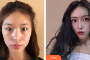 杭州西湖之江眼科醫(yī)院梁遠(yuǎn)波整形價(jià)格表附切開雙眼皮案例展示