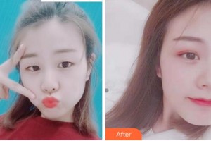 杭州西湖之江眼科醫(yī)院趙向陽整形價格表附眼部綜合案例展示