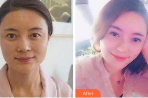 杭州港麗醫(yī)療美容診所童佳奇整形價格表附切開雙眼皮案例展示