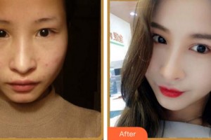 寧波協(xié)和儷人醫(yī)療美容門診部姜宇祿整形價格表附眼部綜合案例展示