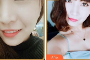 寧波珈禾整形?？漆t(yī)院金正旺整形價格表附眼部綜合案例展示