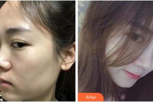 寧波珈禾整形?？漆t(yī)院鮑海萍整形價格表附膨體隆鼻案例展示