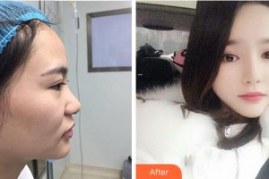 寧波珈禾整形?？漆t(yī)院龔濤整形價格表附鼻部綜合案例展示