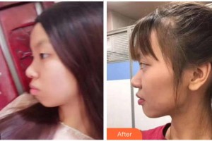 寧波珈禾整形?？漆t(yī)院王昊整形價格表附金屬托槽矯正案例展示