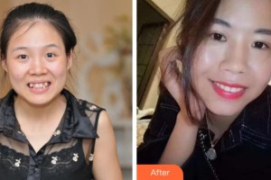 寧波尚麗整形美容醫(yī)院程琳整形價格表附自鎖托槽矯正案例展示