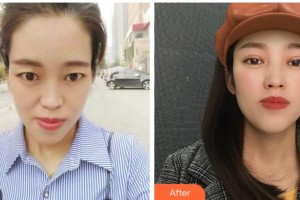 寧波尚麗整形美容醫(yī)院汪蘭主任醫(yī)生整形價格表附切開雙眼皮案例展示